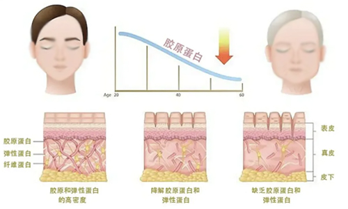 胶原蛋白流失卡通图