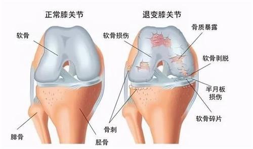 正常膝关节和膝盖关节炎的膝盖对比