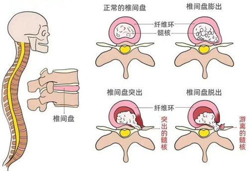 什么是腰椎间盘突出