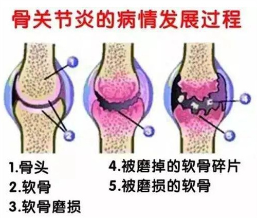 深度揭秘：PRP治疗膝关节，技术成熟度决定成果好不好