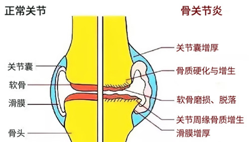 关节的炎症和正常情况表现