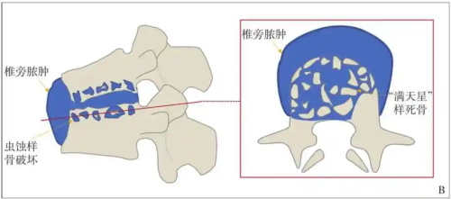 脊柱损伤展示示意图