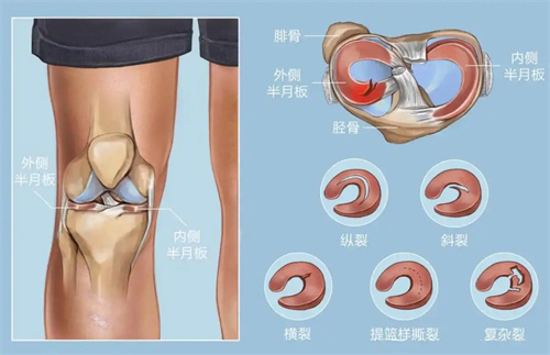 半月板示意图