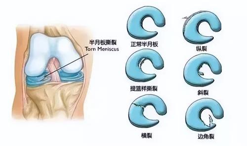 半月板损坏的类型