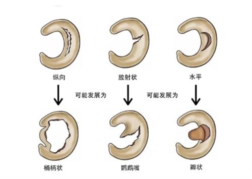 半月板损伤的后果