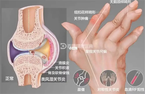 日本干细胞注射治疗关节炎技术成熟吗？这项手术的口碑怎么样？