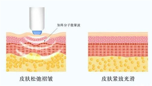 日本干细胞上清液注射可以抗衰老吗？这项医美收费贵不贵？