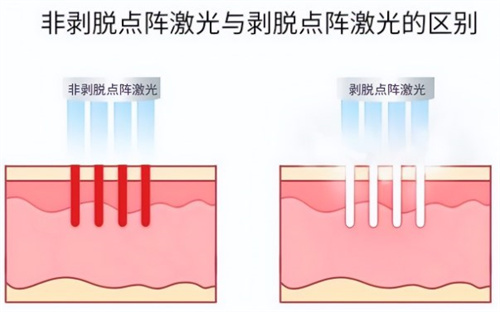 非剥脱点阵激光和剥脱点阵激光
