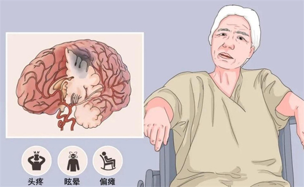 日本脑卒中治疗新突破：自体骨髓疗法如何快速修复神经损伤避免排异反应？