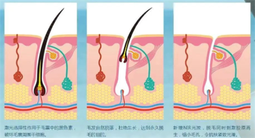 光子脱毛前后变化