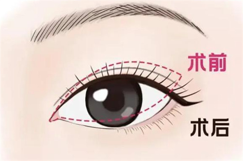 日本贝尔美容外科诊所怎么样?做双眼皮/隆鼻/身体塑形/皮肤科项目口碑好!