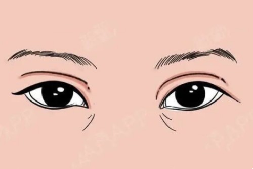 双眼皮失败卡通图