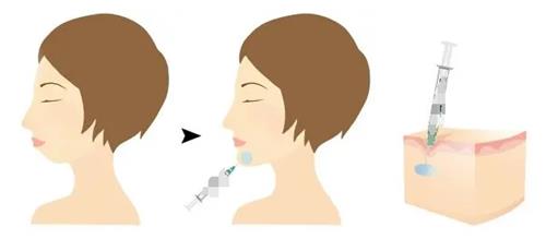 日本让皮肤科整形外科诊所特色项目全解析：不开刀小V脸、AI骨雕隆鼻为何火遍全网？