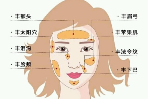 自体脂肪面部填充卡通图一览