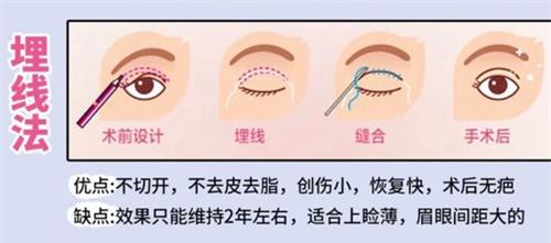 双眼皮手术埋线法动画演示图