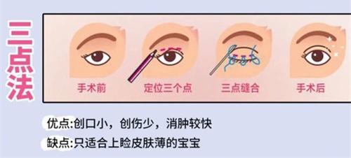 双眼皮手术三点法动画演示图