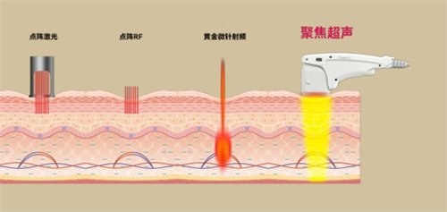 尖峰超声王作用皮肤层次透视图