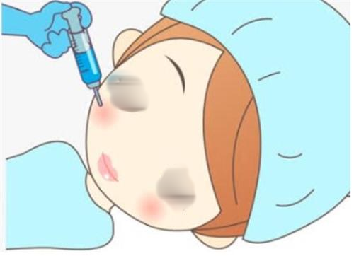 打针瘦脸手术过程图