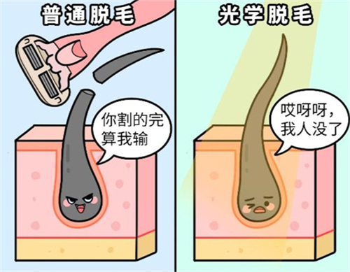 日本贝尔美容外科激光脱毛和普通刮毛的区别