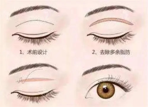 全切双眼皮卡通示意图 全切双眼皮卡通示意图