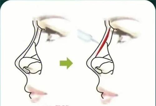 宝尼达玻尿酸注射隆鼻 宝尼达玻尿酸注射隆鼻