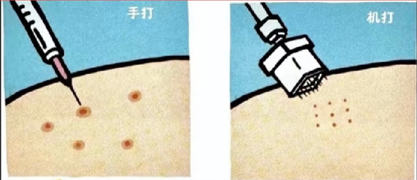 水光针注射 水光针注射