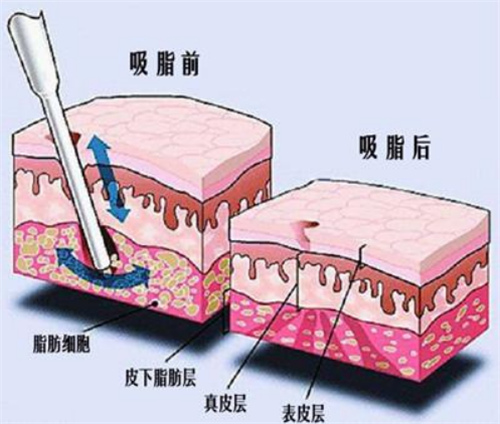 吸脂手术前后对比动画图示