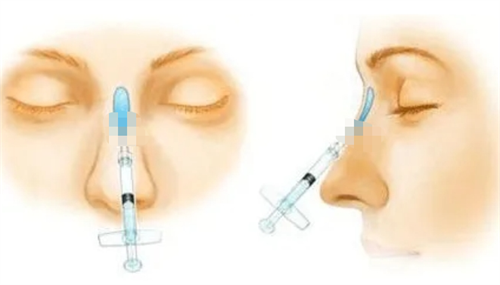 玻尿酸注射隆鼻动画展示图