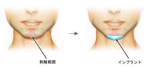 注射垫下巴示意图