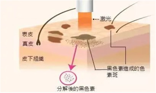 激光祛斑手术原理图 激光祛斑手术原理图