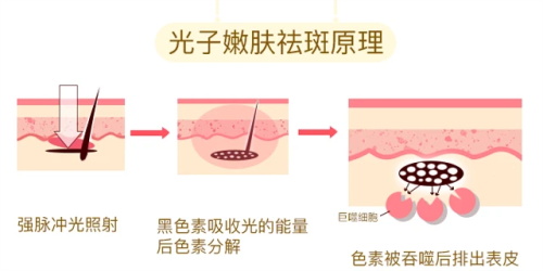 光子嫩肤的祛斑原理 光子嫩肤的祛斑原理