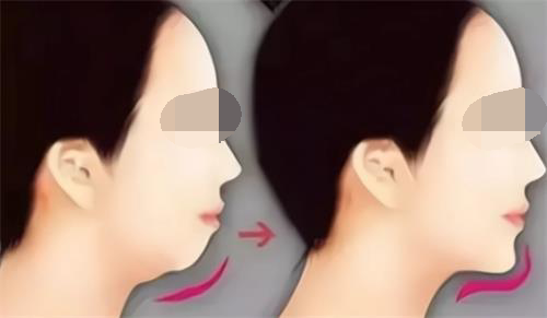 玻尿酸丰下巴后的成效