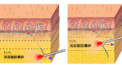 激光溶脂作用皮肤层图 激光溶脂作用皮肤层图