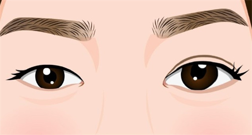 双眼皮手术术前术后对比卡通 双眼皮手术术前术后对比卡通