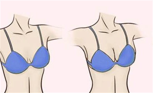 隆胸前后对比图 隆胸前后对比图