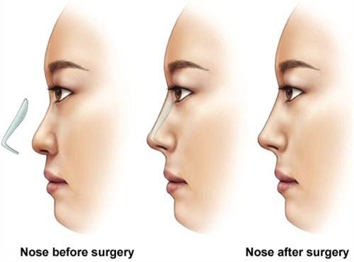 假体隆鼻手术前后对比 假体隆鼻手术前后对比