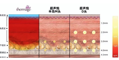 超声炮治疗深度对比