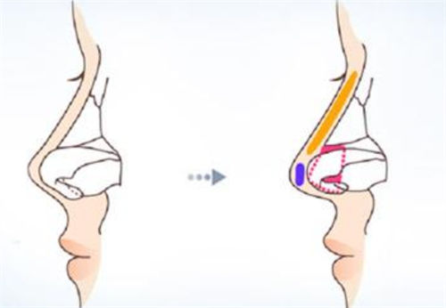 鼻尖鼻梁隆鼻手术前后对比图 鼻尖鼻梁隆鼻手术前后对比图