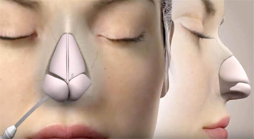 隆鼻手术动画图 隆鼻手术动画图