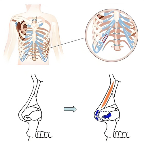 全肋骨隆鼻术手术展示动画图 全肋骨隆鼻术手术展示动画图