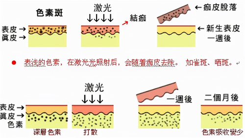 激光祛斑过程 激光祛斑过程