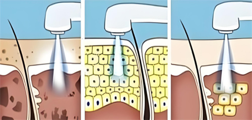 皮秒祛斑 皮秒祛斑